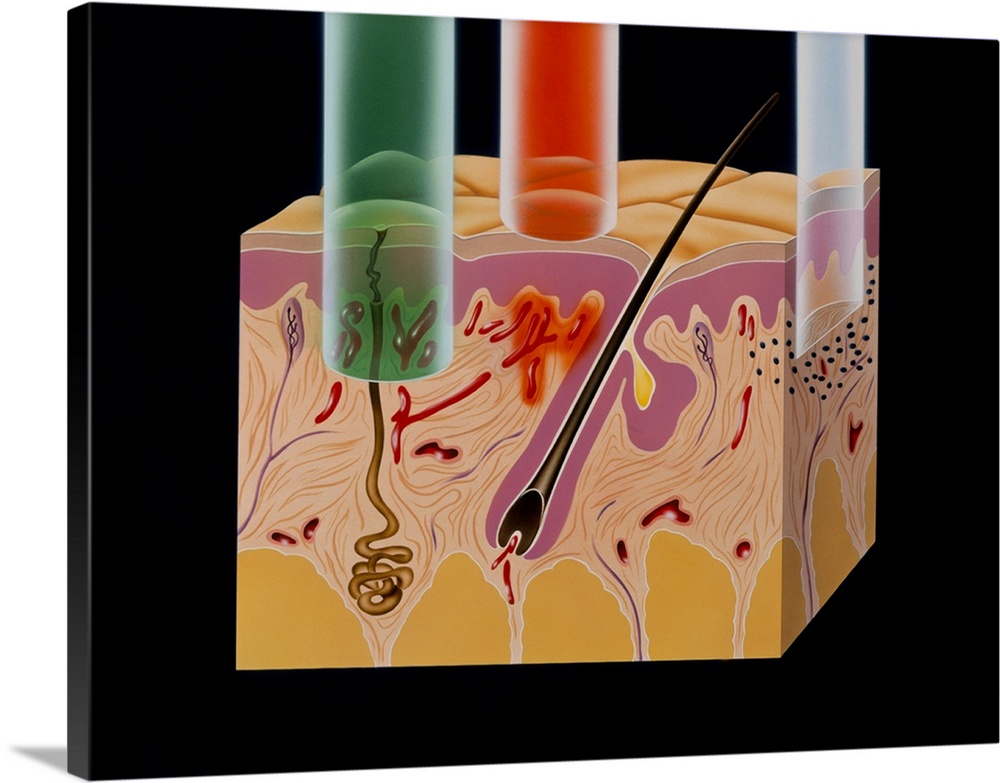 Artwork of a section of human skin showing the relative degree of penetration of three types of laser beams used in medici...