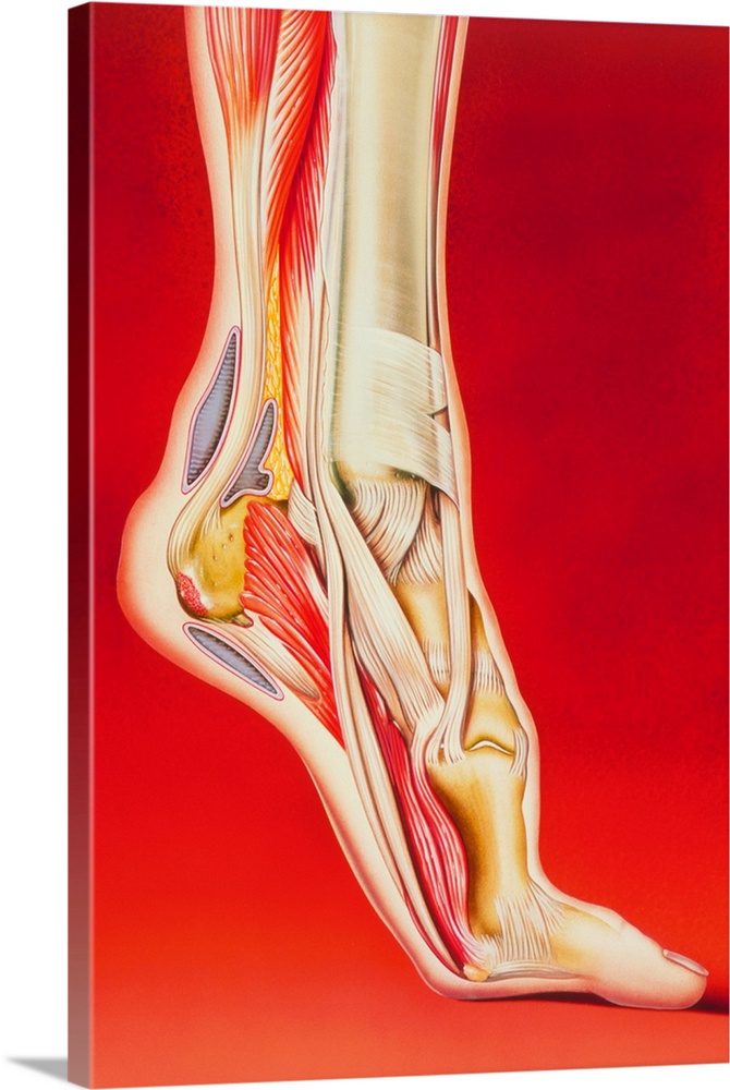 Calcaneal spur and foot pain. Illustration showing causes of pain in the foot. At top left are the calf muscles which atta...