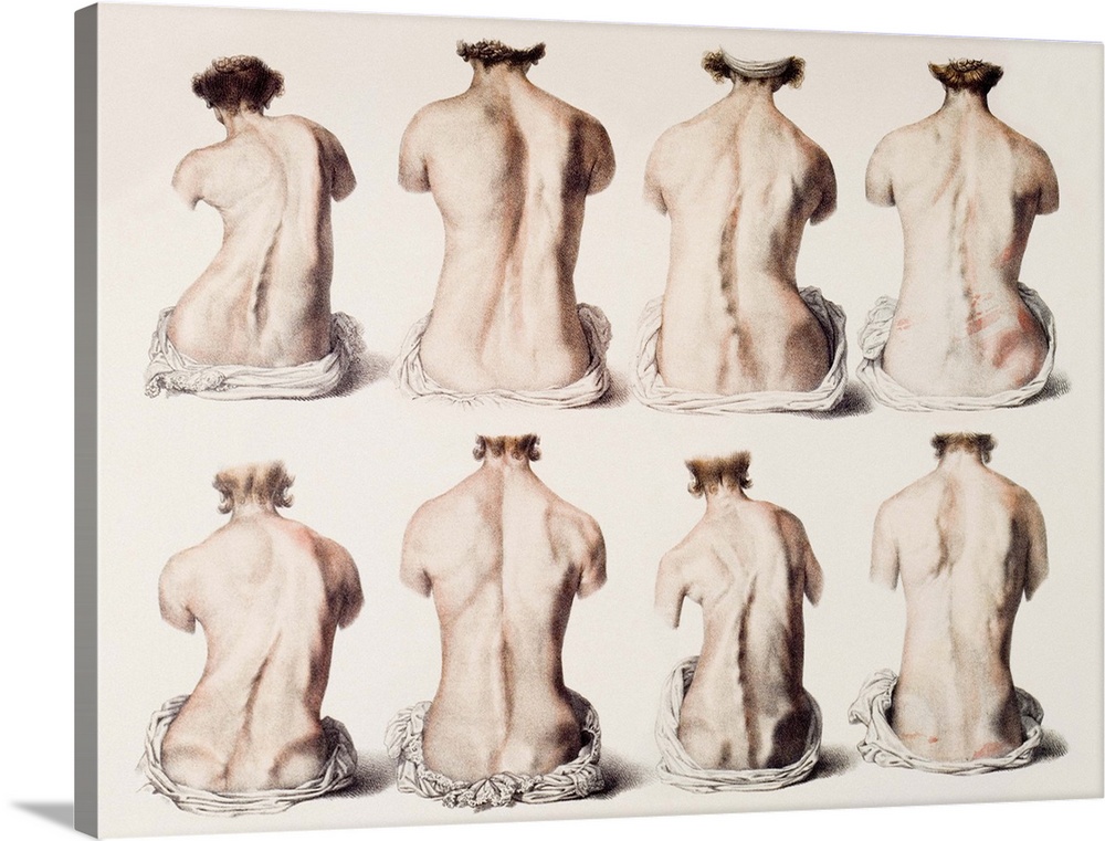 Back deformities, historical anatomical artwork. These patients all have spinal deformities leading to abnormal curvatures...