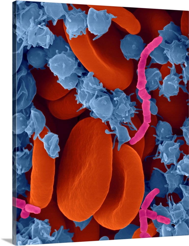 Bacterial blood infection caused by a rod shaped bacterium, composite coloured scanning electron micrograph (SEM). Short c...