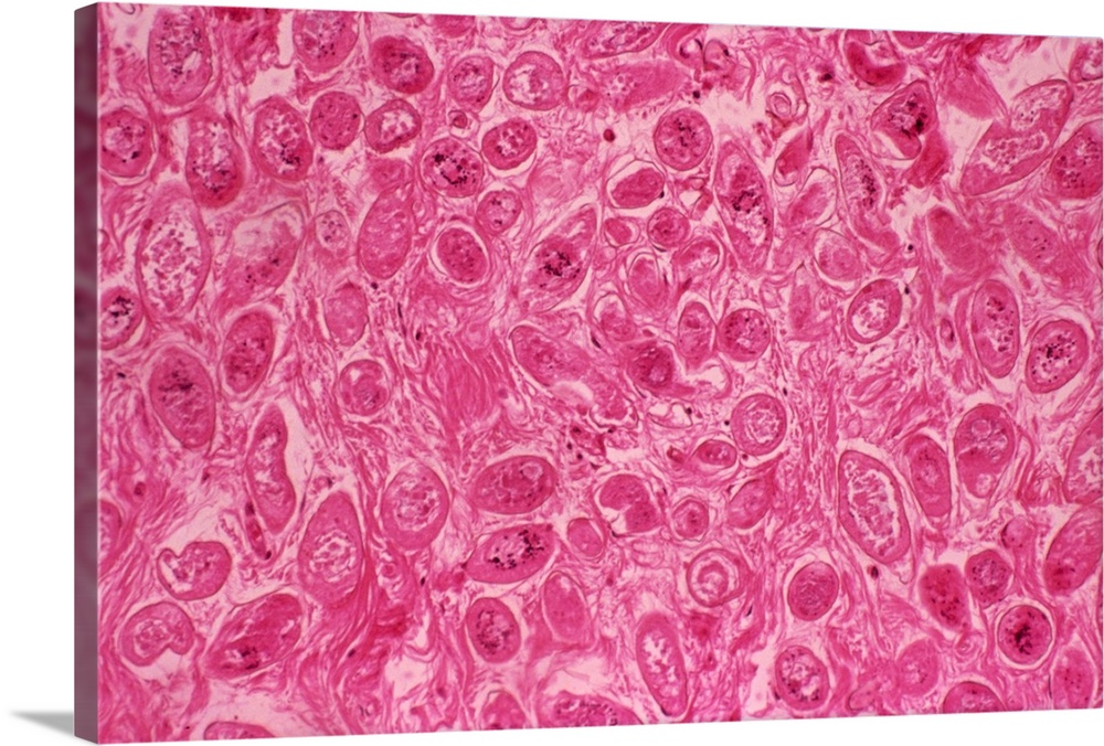 Bilharzia infection. Light micrograph of human ureter tissue that contains numerous eggs from Schistosoma flukes. The uret...