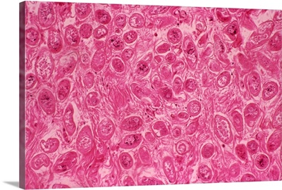 Bilharzia infection, ureter tissue