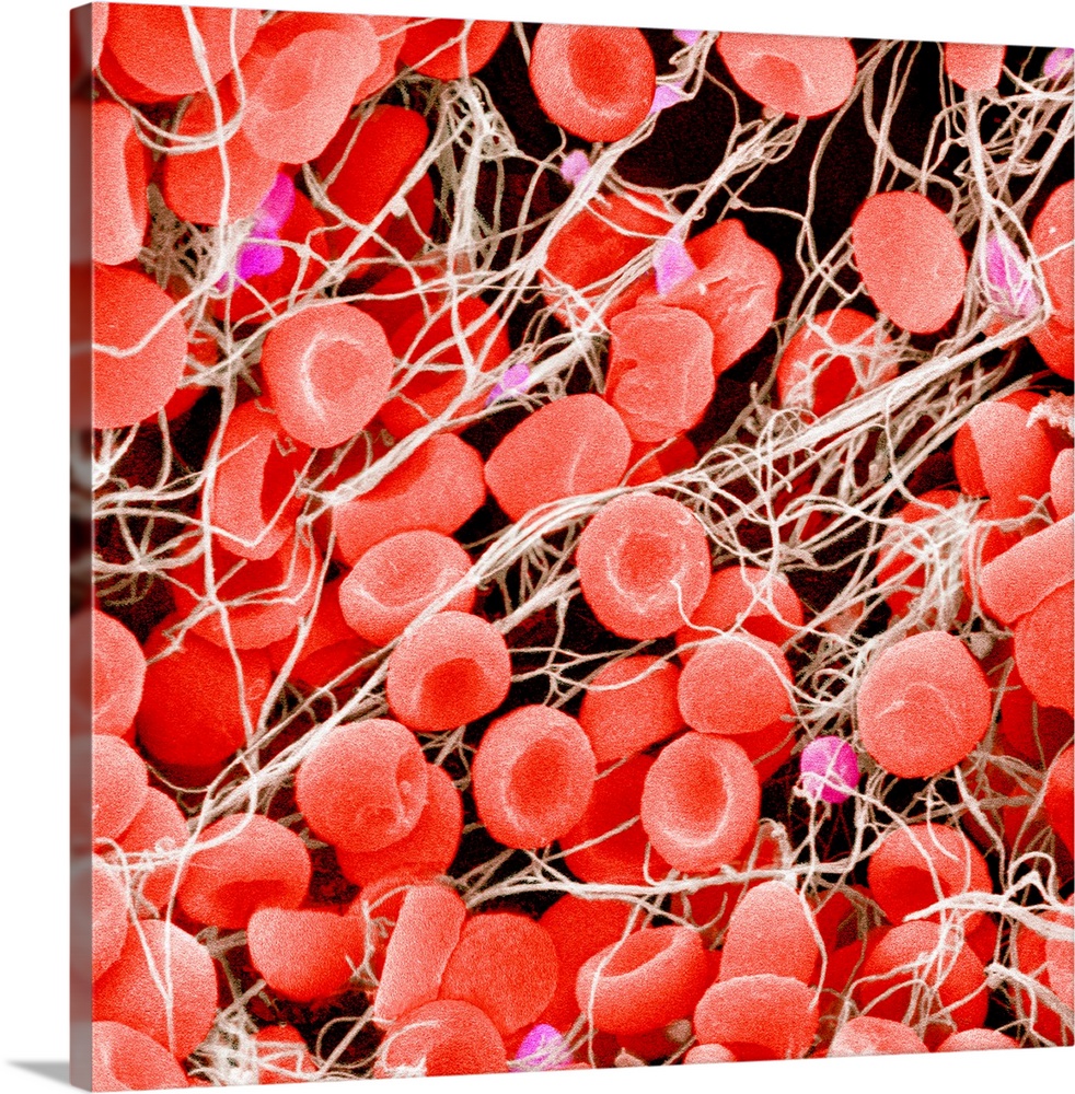 Blood clot, coloured scanning electron micrograph (SEM). Red blood cells (erythrocytes) are trapped within a fibrin protei...