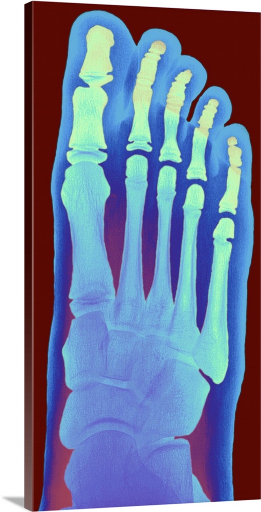 Child's foot. Coloured X-ray of the healthy right foot of an eight year old girl. The toes are made up of the phalanx bone...