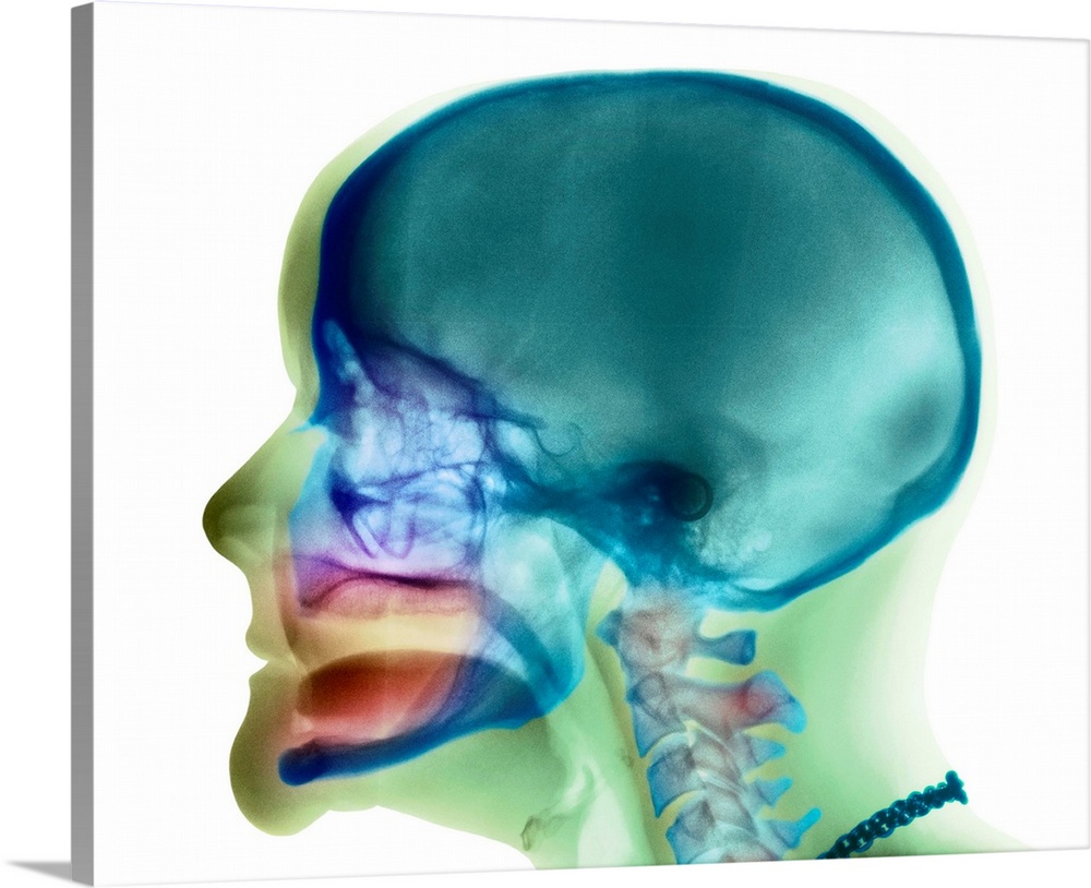 Loss of teeth. Coloured X-ray (side view) of the head of a 49 year old woman showing complete loss of teeth in both upper ...