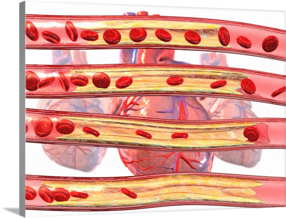 Coronary artery disease. Computer artwork of red blood cells flowing through an increasingly (top to bottom) blocked coron...