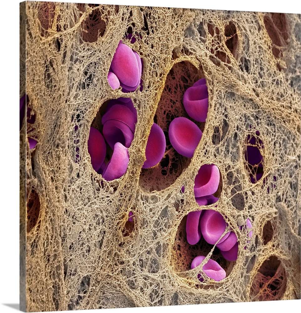 Coronary blood clot. Coloured scanning electron micrograph (SEM) of a blood clot (thrombus) in the coronary artery, showin...