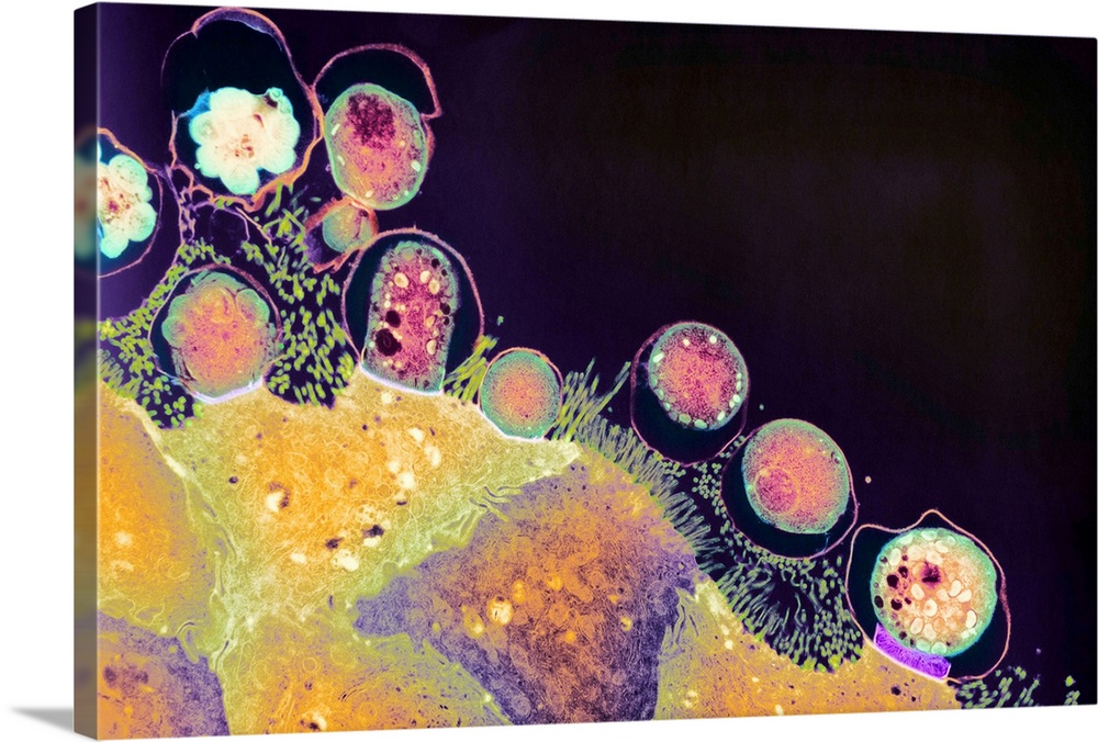 Cryptosporidiosis. Coloured transmission electron micrograph (TEM) of an intestinal surface (orange) infected with Cryptos...