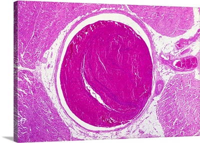 Deep Vein Thrombosis, Light Micrograph
