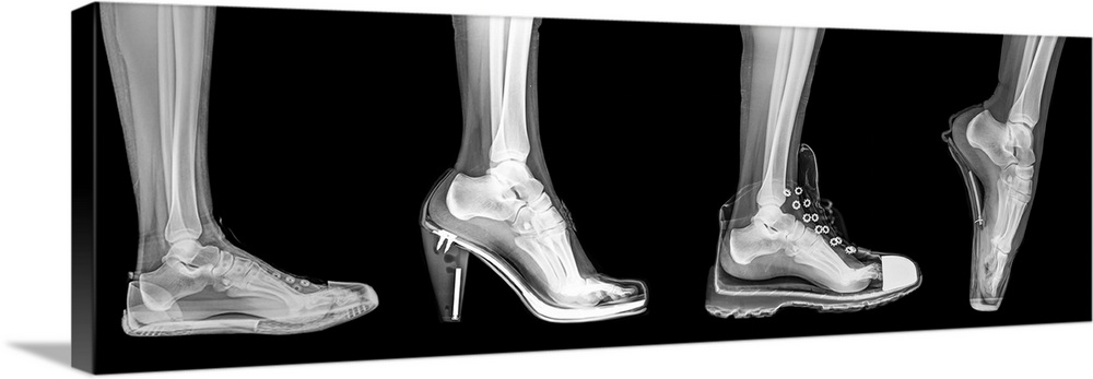 X-ray of a woman's foot in 4 different shoes (from left to right) Trainers, High Heel, Running and Ballet