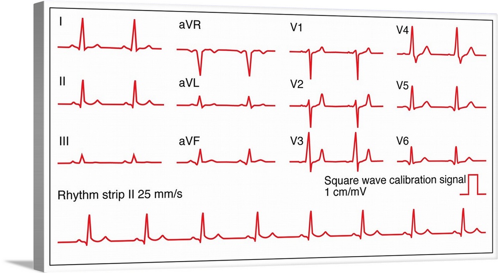Electrocardiograms (ECG) of a normal heart rate, artwork. An ECG measures the electrical activity of the heart. The wave o...