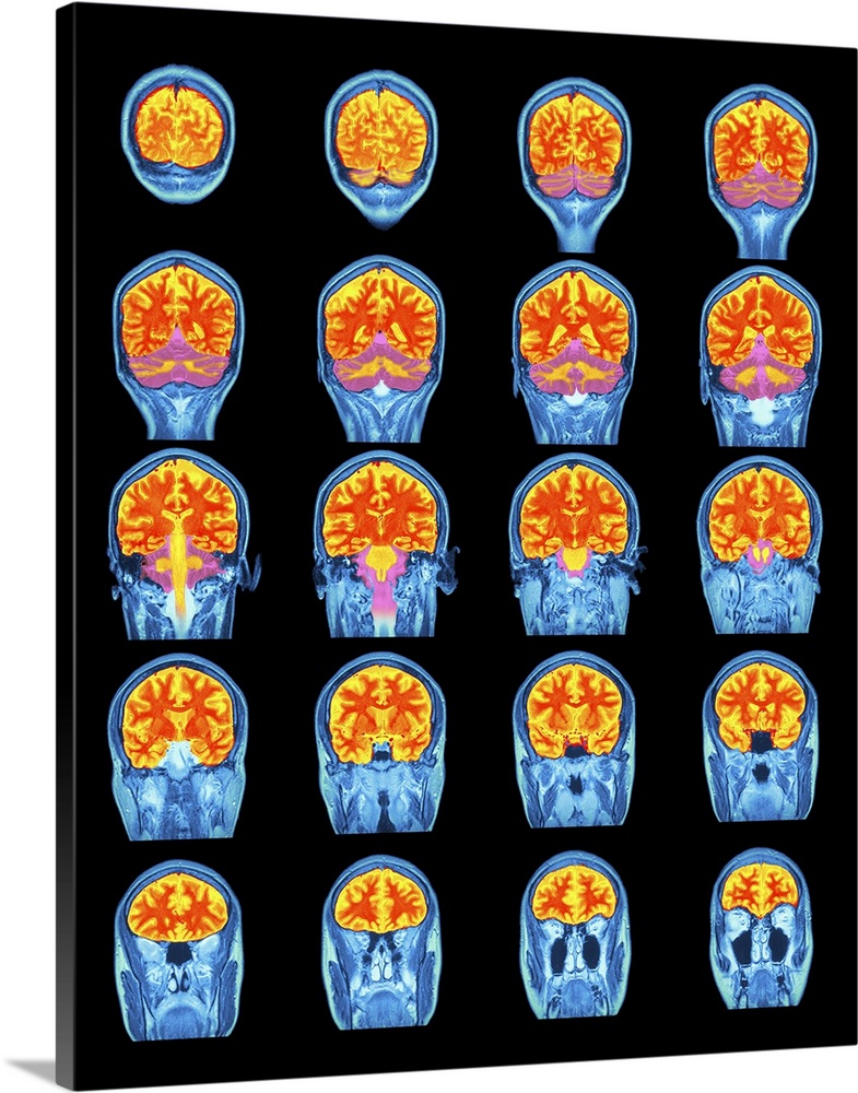 Healthy brain. Coloured magnetic resonance imaging (MRI) scans through the head of a 31 year old woman, showing the brain ...