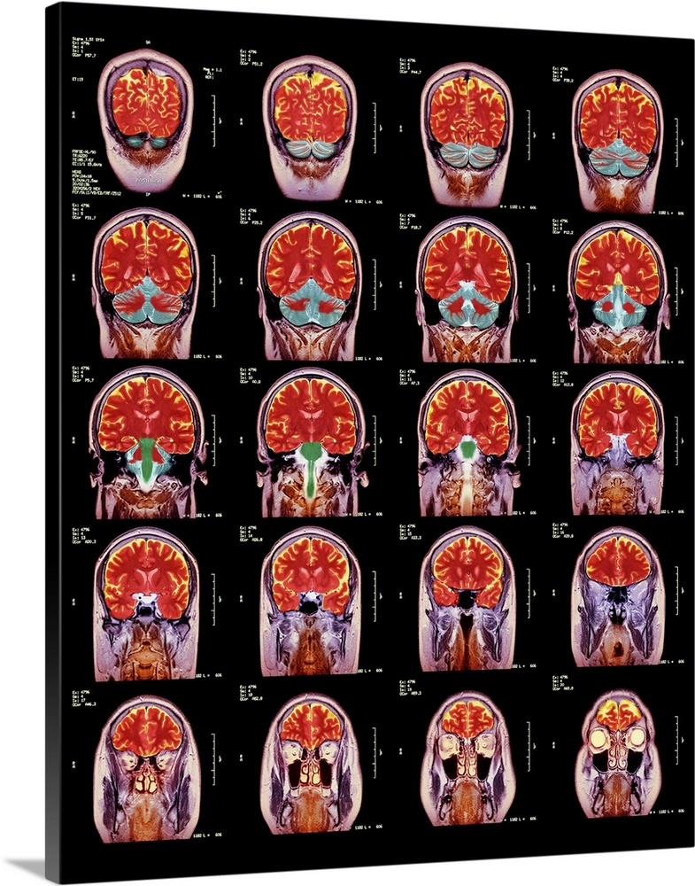 Healthy brain. Coloured magnetic resonance imaging (MRI) scans through the head of a 55 year old man, showing the brain se...