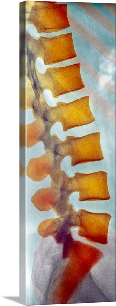 Healthy spine. Coloured X-ray of a side view of the healthy lower (lumbar) spine of an adult man. The front of the body is...