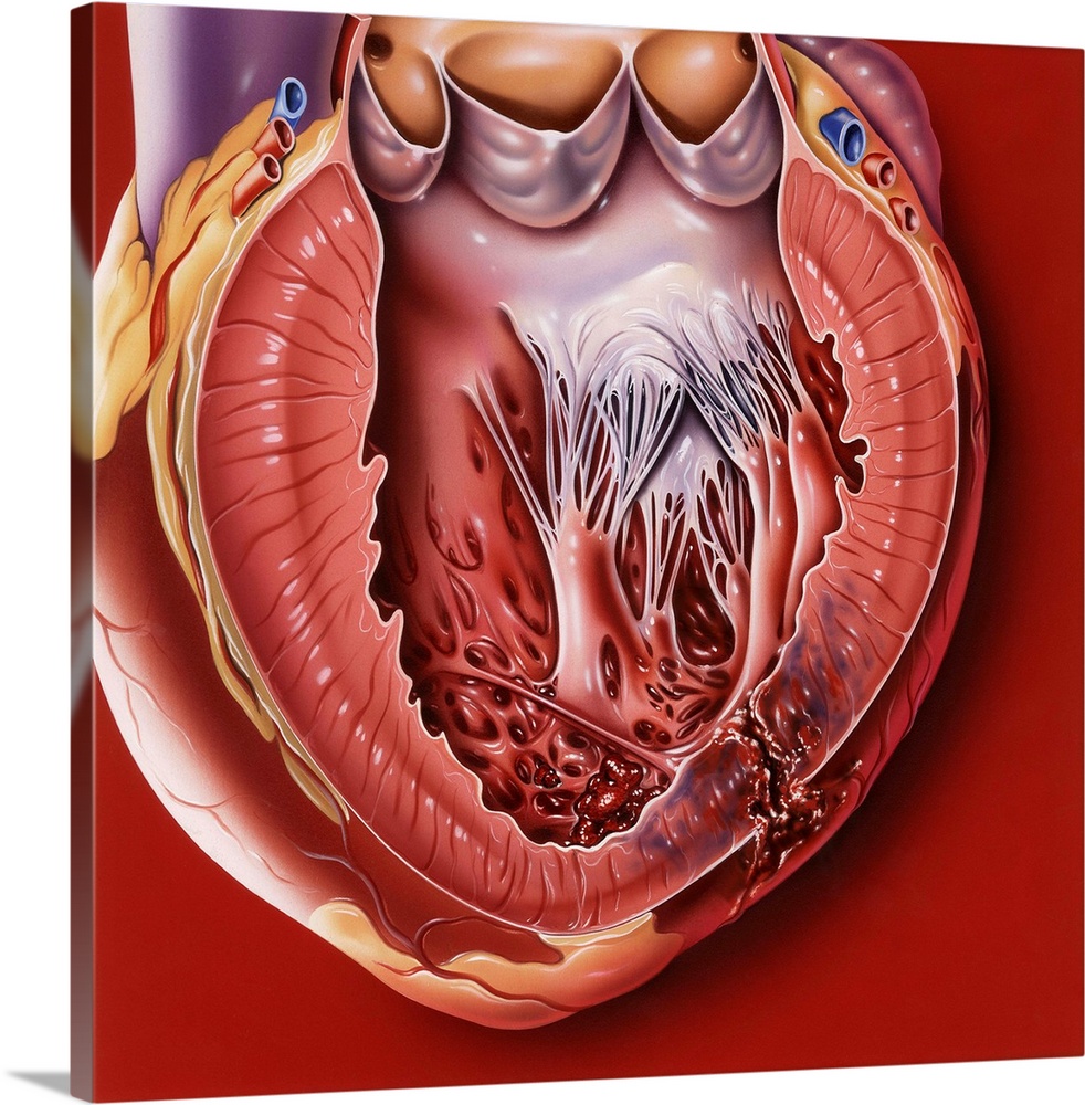 Heart disease. Computer artwork of a sectioned heart showing a myocardial rupture (bottom right) in the left ventricle (lo...