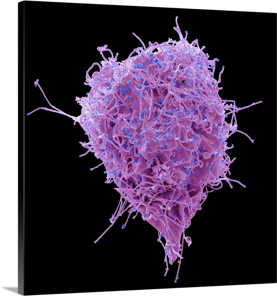 HIV infected 293T cell. Coloured scanning electron micrograph (SEM) of a 293T cell infected with the human immunodeficienc...