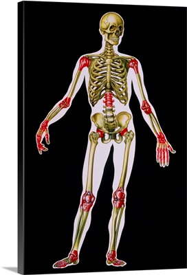 Illustration of arthritis sites on the body