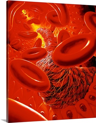 Interior of human blood vessel showing a thrombus