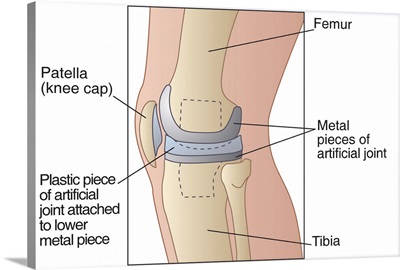Knee replacement, artwork