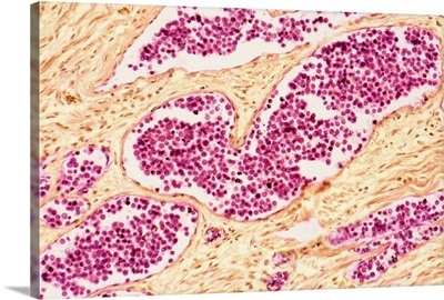 Leukemia blood cells, light micrograph