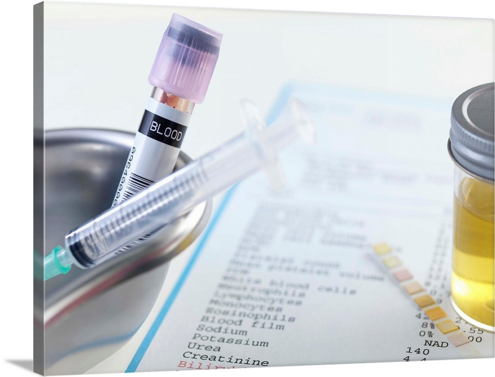 Medical testing. Blood sample in a kidney dish, with a urine sample and test strip on a sheet of paper listing the test re...