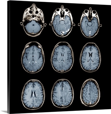 Normal brain, MRI scans