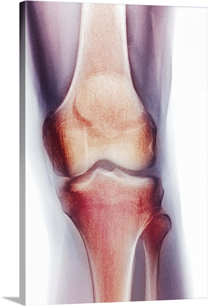 Normal knee, coloured frontal X-ray. The tibia (shin bone, bottom centre) and the smaller fibula (bottom right) articulate...
