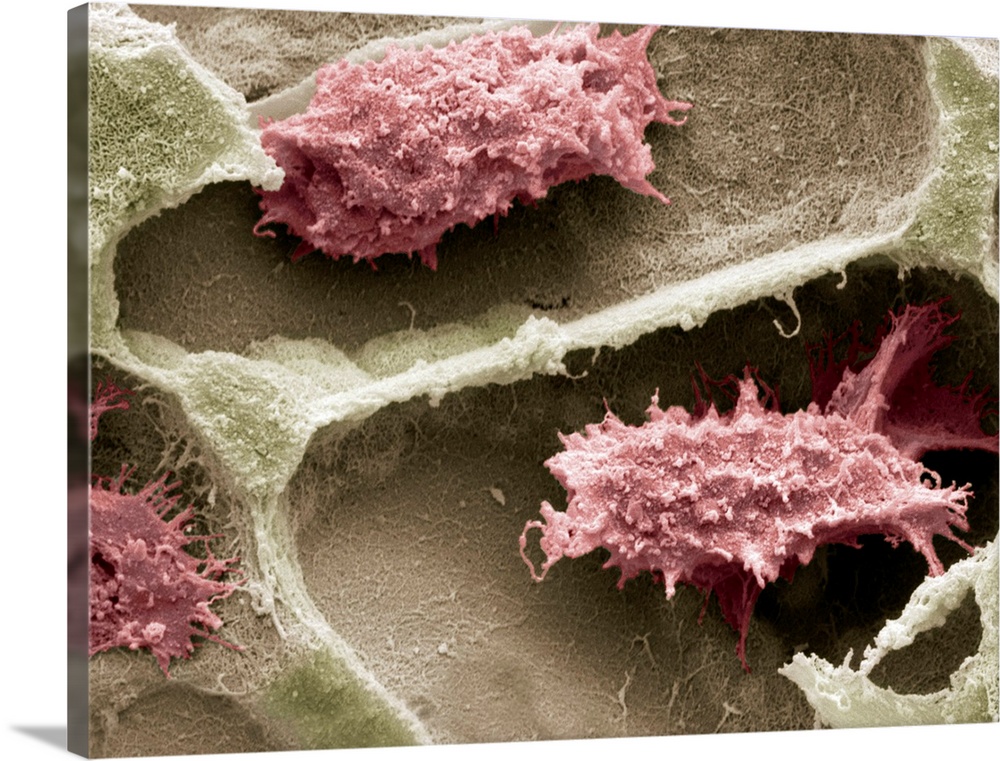 Osteoclasts in bone lacunae, coloured scanning electron micrograph (SEM). These osteoclasts are seen in Howslips lacunae, ...