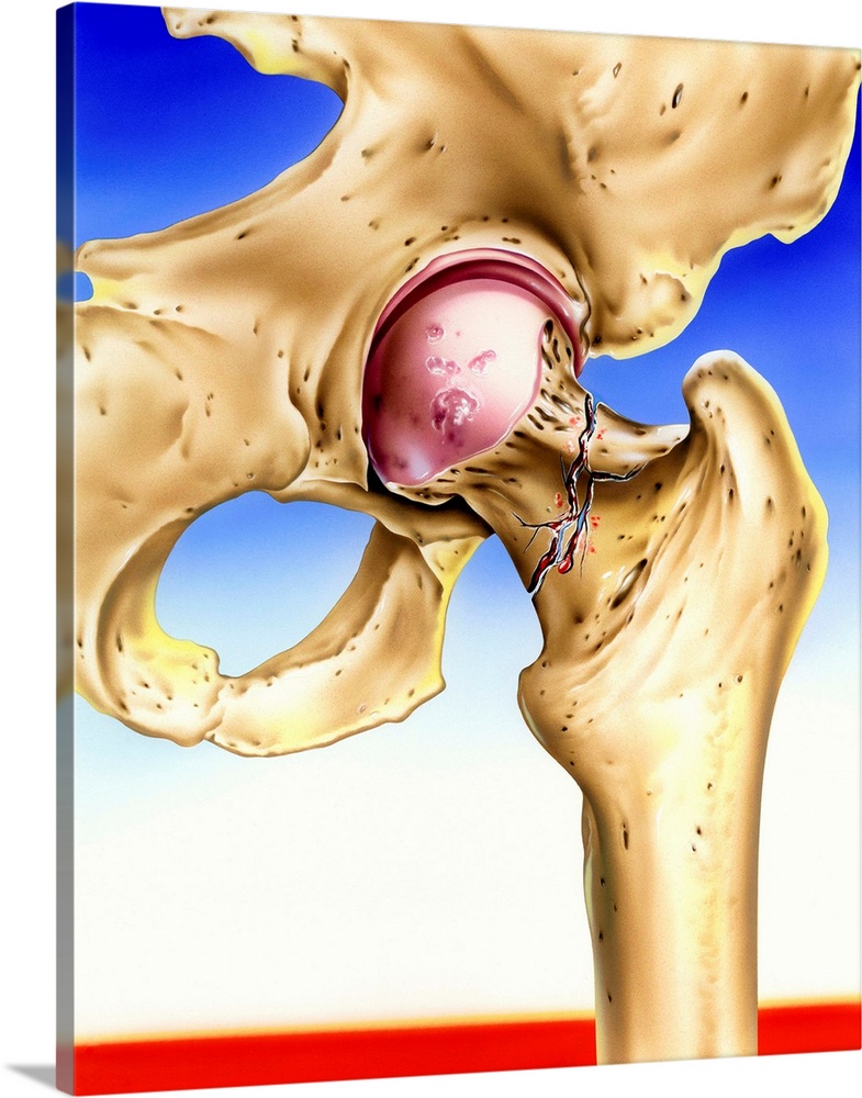 Osteoporosis. Artwork of a hip joint where the neck of the femur (thigh bone) has fractured due to osteoporosis. Osteoporo...