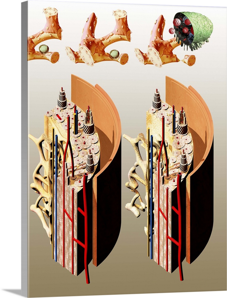 Osteoporosis. Computer artwork showing the anatomy of normal (left) and osteoporotic (right) bone. A bone shaft consists o...