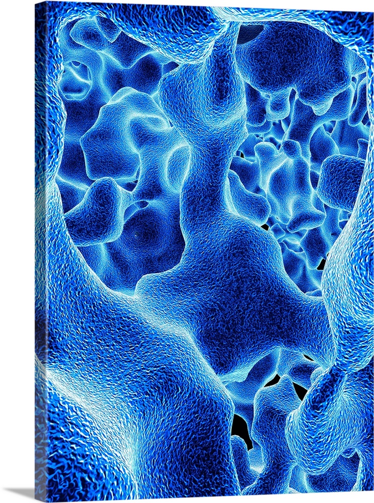 Osteoporosis. Computer artwork of the trabeculae in the cancellous (spongy) bone tissue affected by osteoporosis. The canc...