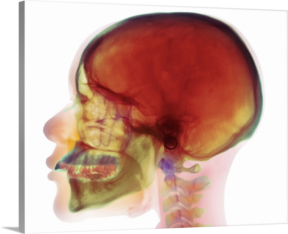 Overbite. Coloured X-ray (side view) of the head of a 32 year old woman showing overbite of the upper jaw (blue) and its t...