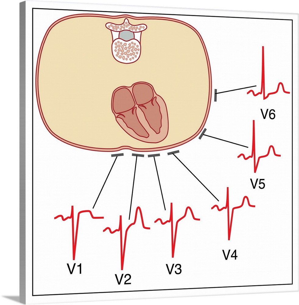 Placing of electrodes for electrocardiogram (ECG), artwork. This diagram shows where the six electrodes attached to the ch...