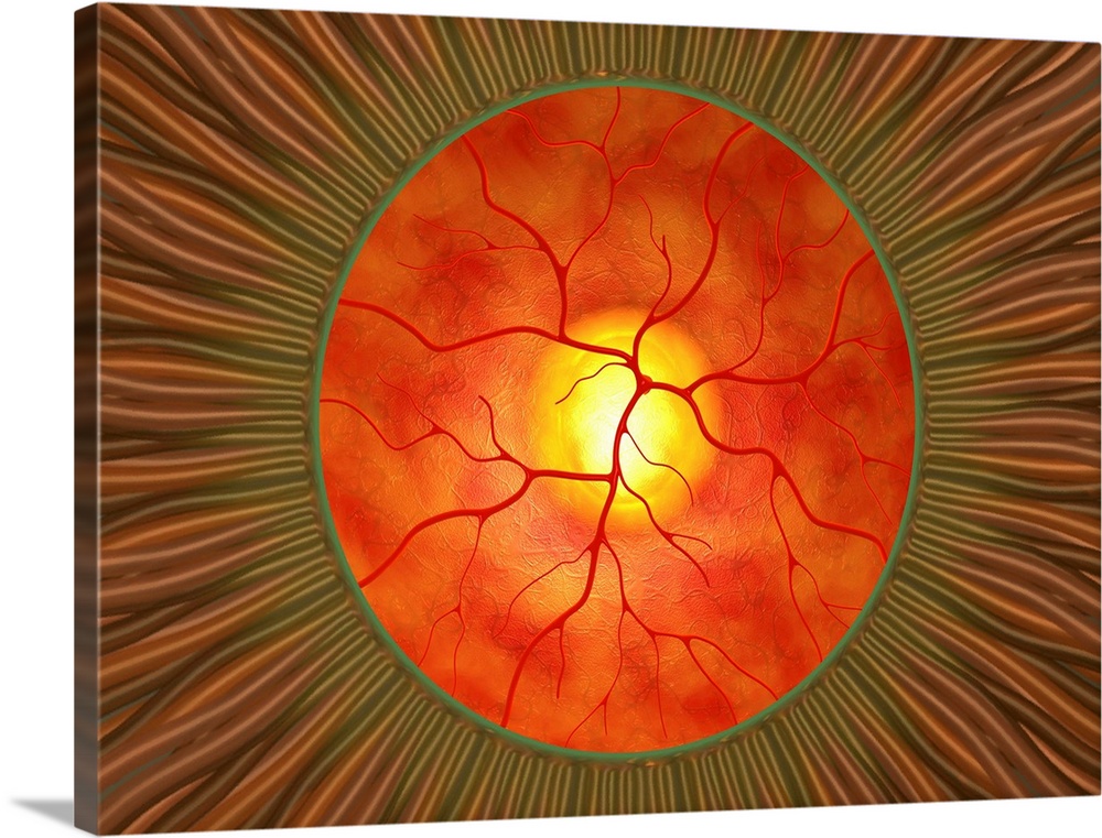 Retina in glaucoma, computer artwork. This view is looking through the pupil (green ring) at the front of the eye, to the ...