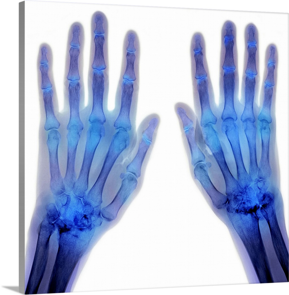 Coloured X-ray (top view) of the hands of a patient, showing rheumatoid arthritis affecting some of the joints at the base...