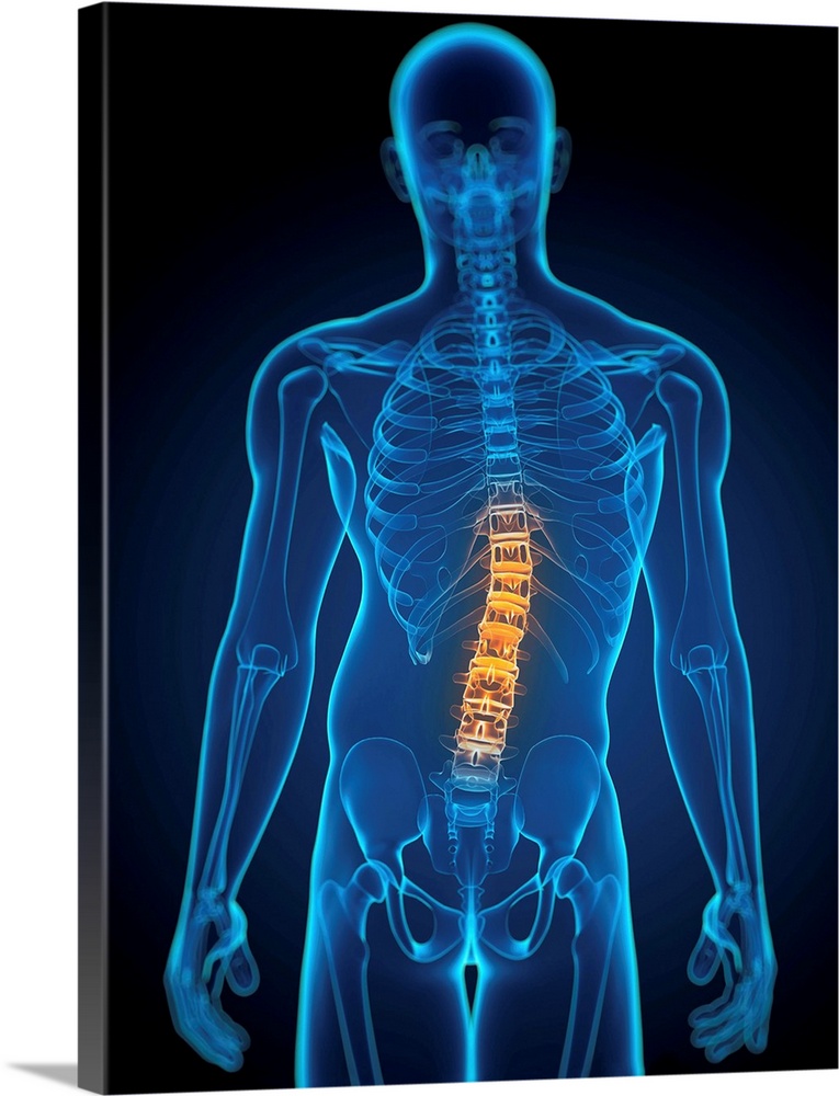 Scoliosis. Computer artwork of a man with a sideways curvature (scoliosis) of the spine.