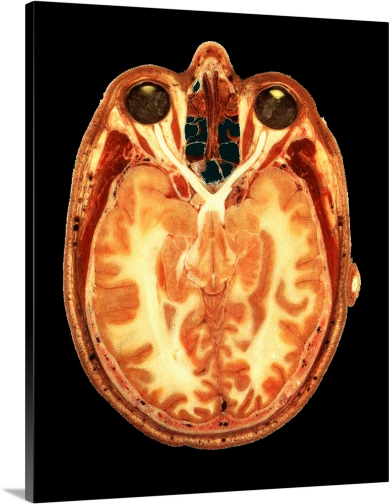 Section through a human head. Axial (transverse) slice through the healthy human head of a male, showing brain and eyes in...