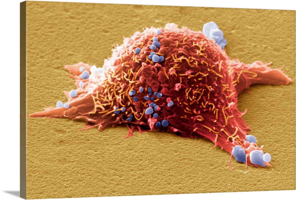 Skin cancer cell, coloured scanning electron micrograph (SEM). Cultured melanoma cell showing the numerous blebs (blue) an...