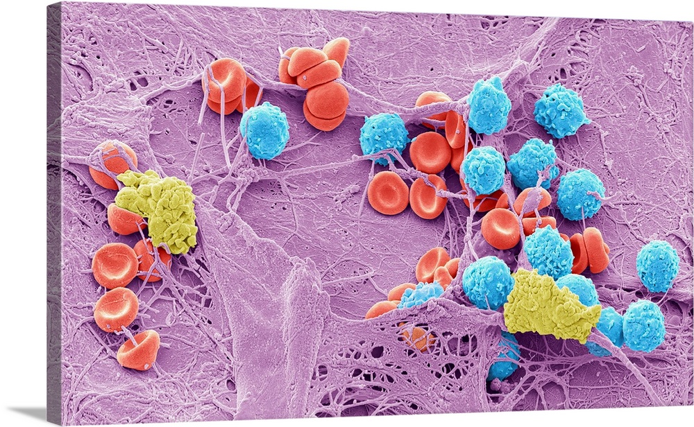 Skin wound, Coloured scanning electron micrograph (SEM). A fibrin mesh supports a variety of blood cells at the site of an...