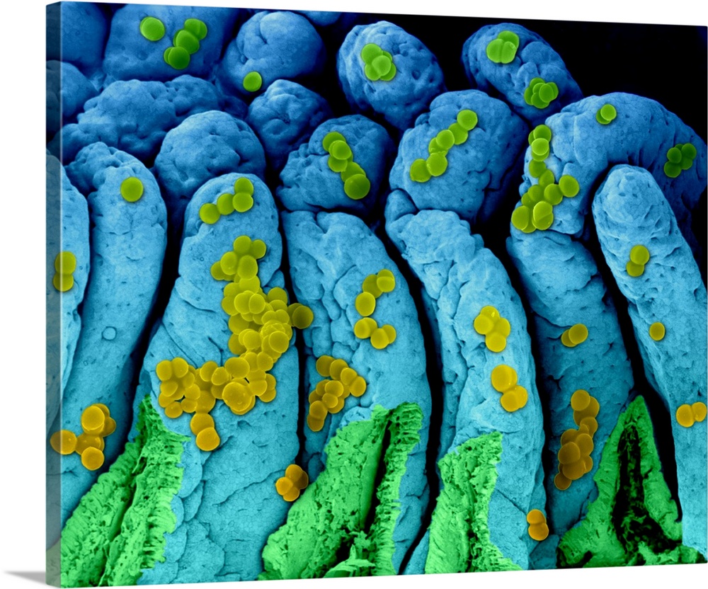 Composite coloured scanning electron micrograph (SEM) of Staphylococcus aureus bacteria (round) on the surface of small in...