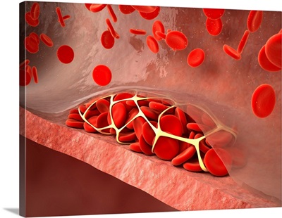 Thrombosed Blood Vessel, Artwork