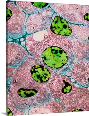 Thyroid cancer cells
