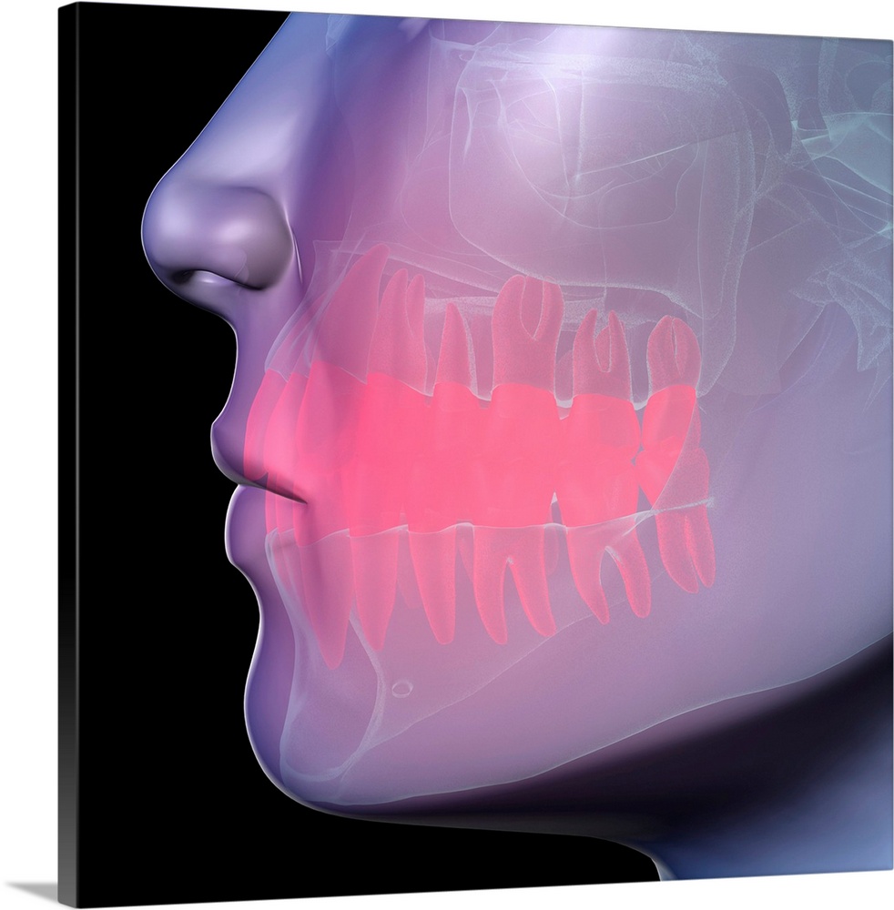 Toothache. Conceptual computer artwork showing pain (represented as the red area) in the teeth. The bones (white) of the m...