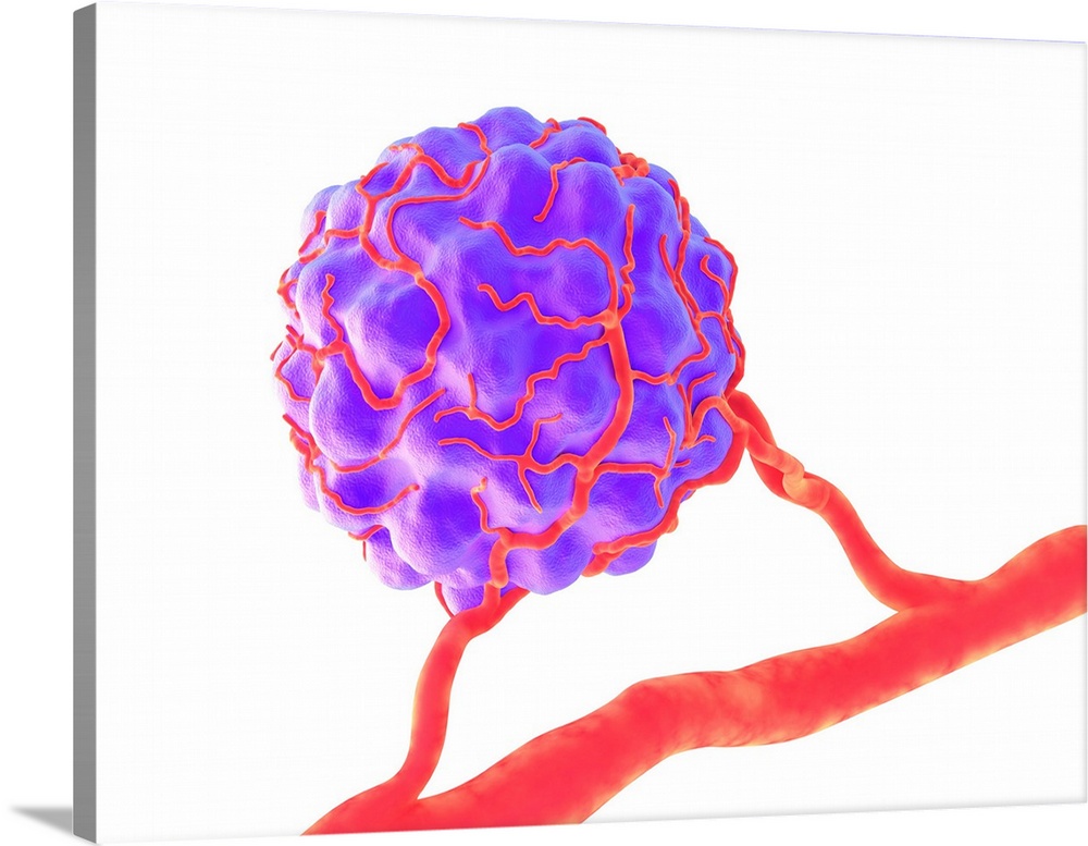 Tumour, computer artwork. Tumours are caused by the uncontrolled growth of previously normal cells. The resulting growth (...