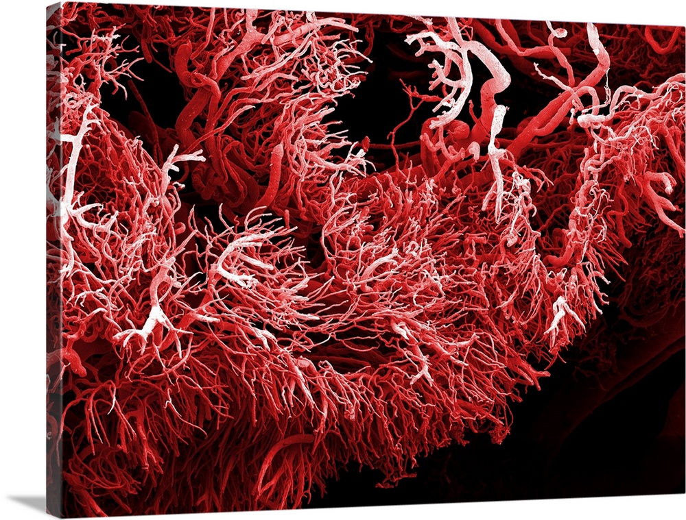 Tumour blood vessels. Coloured scanning electron micrograph (SEM) of a resin cast of blood vessels from an intestinal tumo...