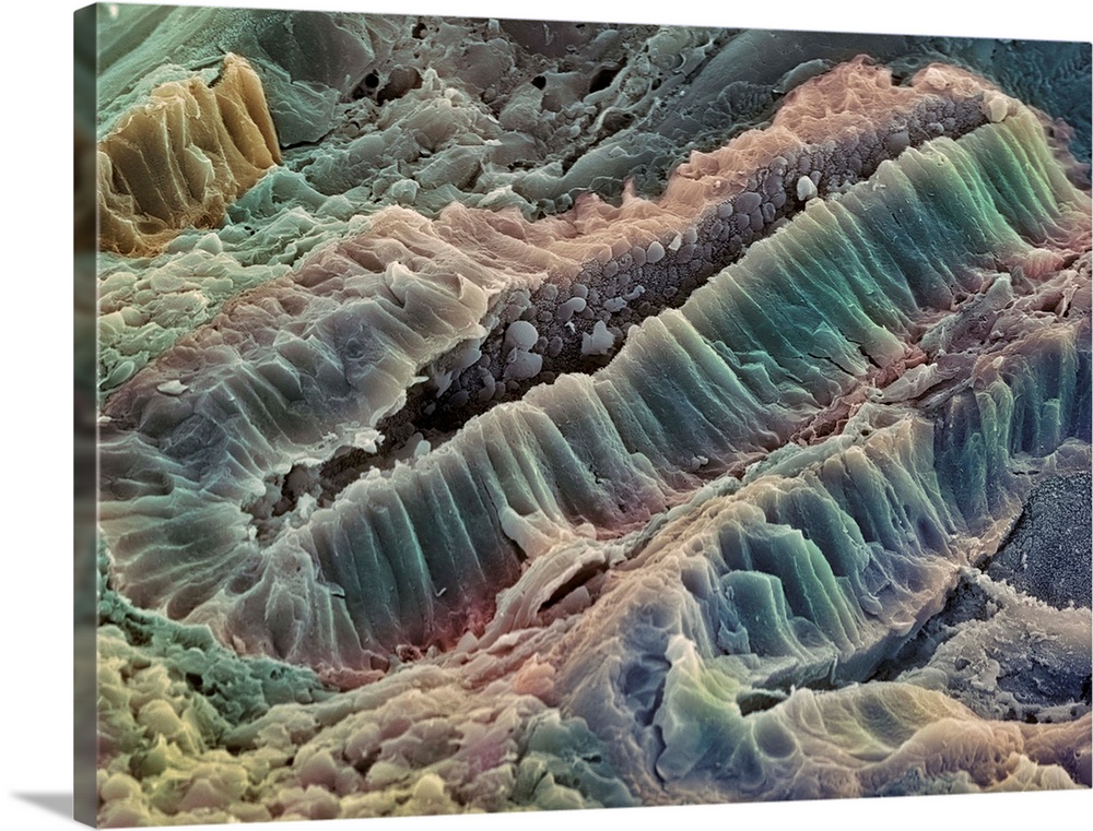 Ulcerative colitis. Coloured scanning electron micrograph (SEM) of freeze-fractured bowel tissue from a patient suffering ...
