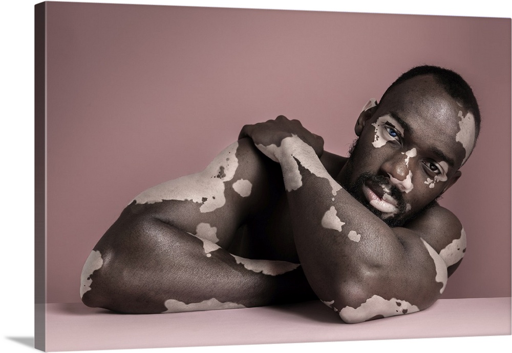 Fashion Portrait Of Black Man With Vitiligo