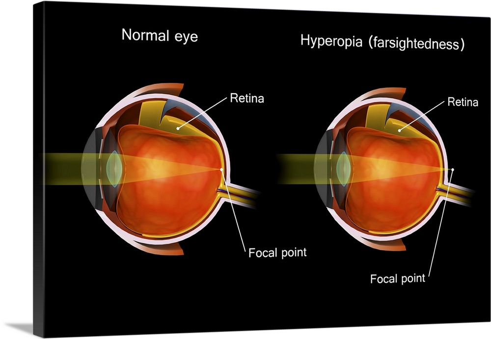 Comparison of a normal eye and an eye with hyperopia.