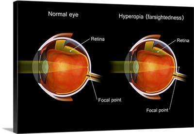 Comparison Of A Normal Eye And An Eye With Hyperopia