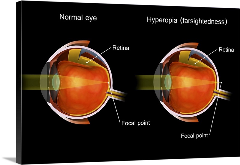 comparison-of-a-normal-eye-and-an-eye-with-hyperopia-wall-art-canvas